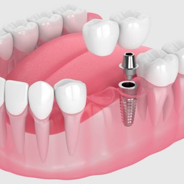 How Soon After Extraction Can You Get A Dental Bridge?